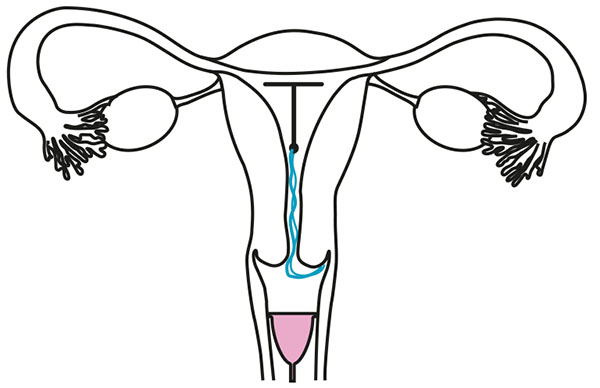 Diagram showing correct placement of menstrual cup
