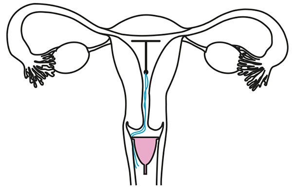 Diagram showing incorrect placement of menstrual cup